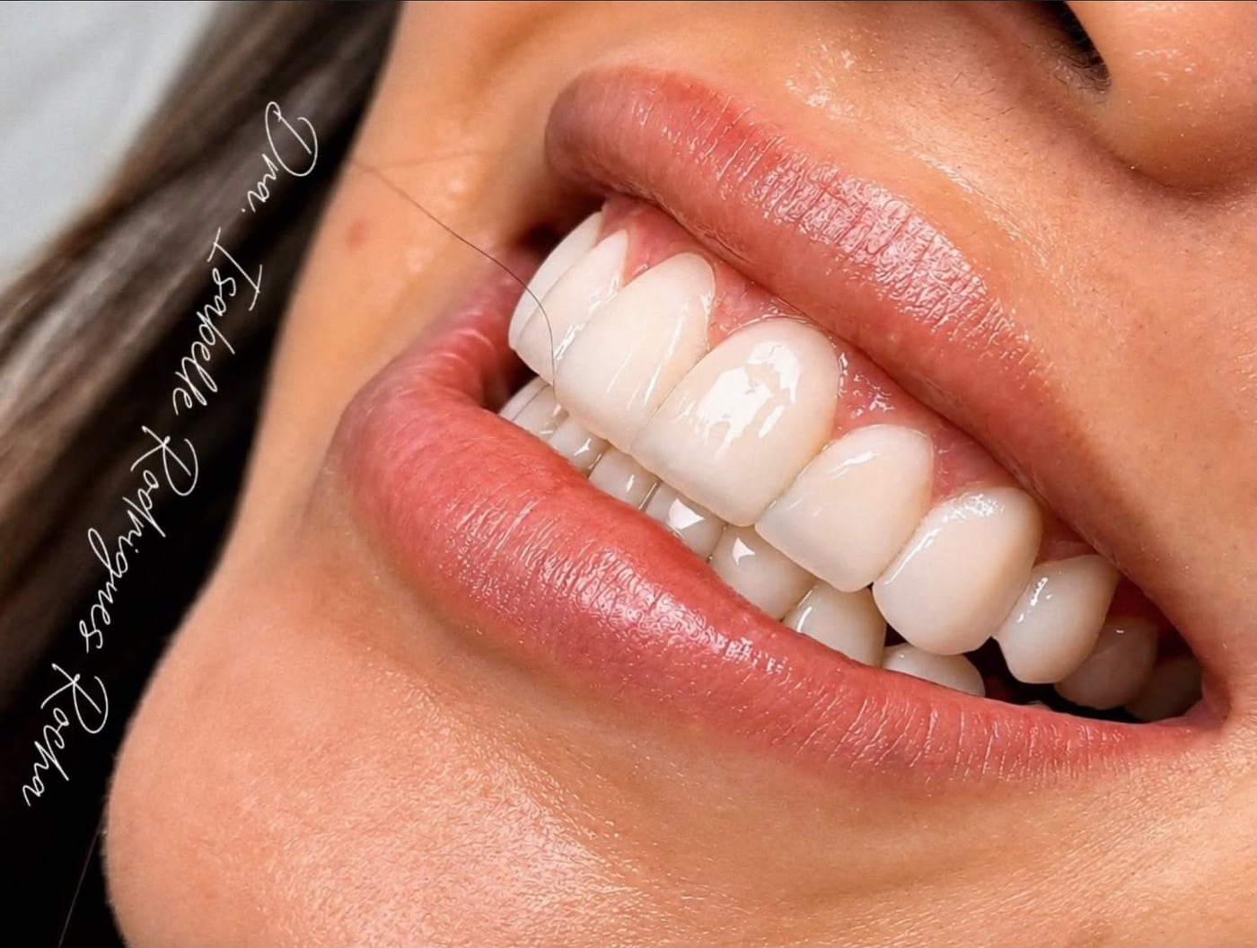 Sorriso de paciente com dentes harmonizados após tratamento